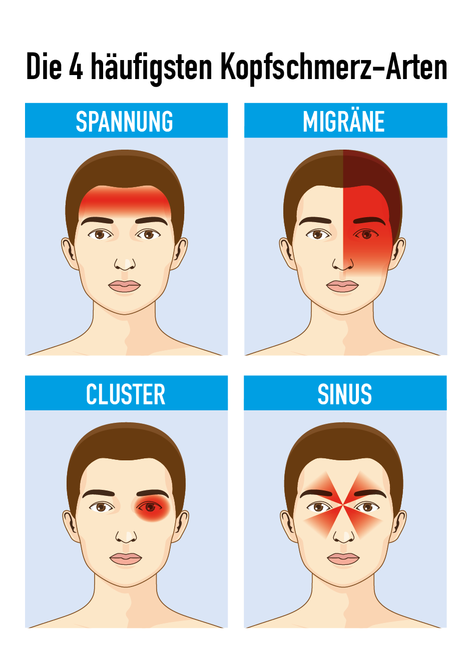 Häufige Arten von Kopfschmerzen: Spannung, Migräne, Cluster, Sinus